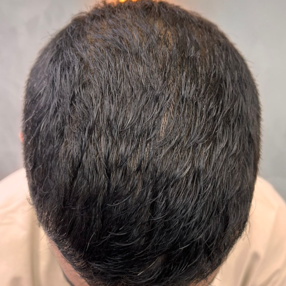 Antes y despues | Capilo Innovación | Medicina Capilar en Medellín