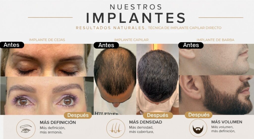 Implante Capilar, de Cejas y Barba | Capilo Innovación | Medicina Capilar en Medellín