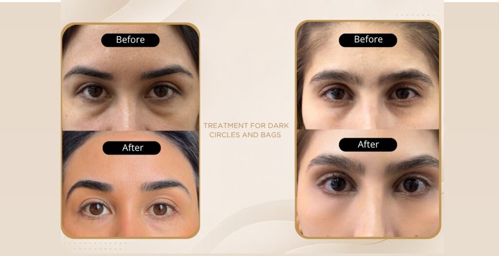 Tratamiento de Ojeras y Bolsas | Capilo Innovación | Medicina Capilar en Medellín